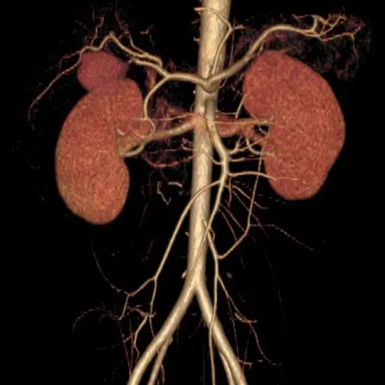 CT Angiography Renal Vessel